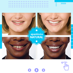 Snap On Smile – Lente Dental